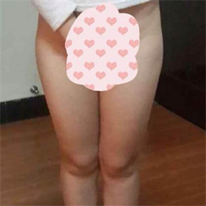 看看我大腿吸脂的恢復(fù)果圖片吧，是東方和諧王自謙做的