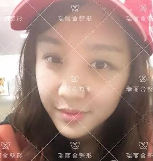 面部填充手術(shù)第4天