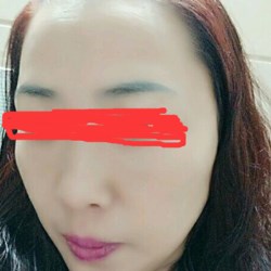 北京邦定張亞昆做的面部提升，果較為不錯(cuò)~