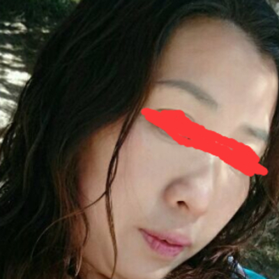 北京邦定張亞昆做的面部提升，果較為不錯(cuò)~