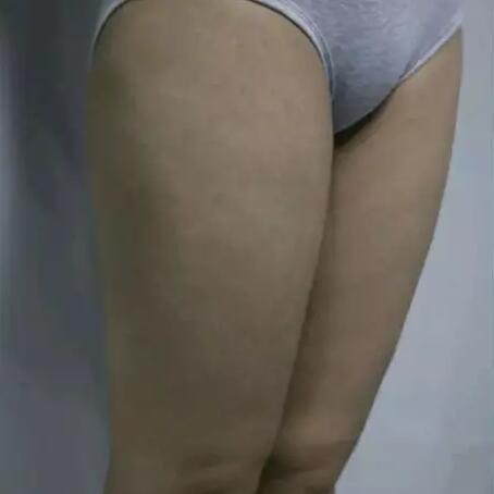 哈醫(yī)大二院整形科徐學(xué)武大腿吸脂術(shù)前后恢復(fù)分享手記