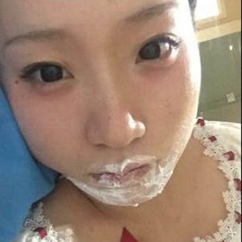北京麗詩(shī)麗格楊明強(qiáng)玻尿酸豐唇半個(gè)月了，看看果~