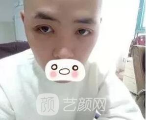 愛(ài)思特張姣姣雙眼皮案例照片日記 男生也會(huì)做雙眼皮手術(shù)哦