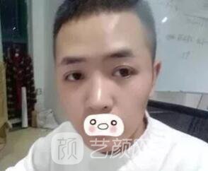 愛(ài)思特張姣姣雙眼皮案例照片日記 男生也會(huì)做雙眼皮手術(shù)哦