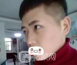 愛(ài)思特張姣姣雙眼皮案例照片日記 男生也會(huì)做雙眼皮手術(shù)哦