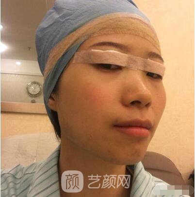 莊璐全切雙眼皮照 全過程恢復(fù)經(jīng)驗(yàn)之談