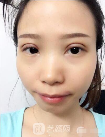 莊璐全切雙眼皮照 全過程恢復(fù)經(jīng)驗(yàn)之談