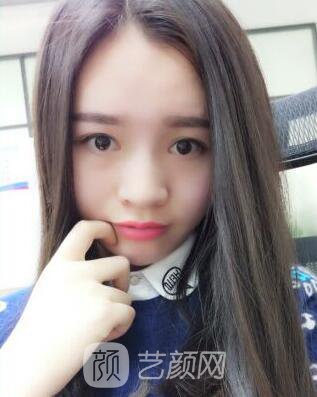 福州比華利林秋蓉激光祛痘圖 滿臉痘痘到光滑肌膚