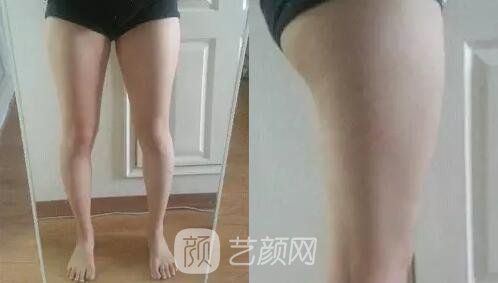 東莞締美陳星光大腿吸脂照片 內附全部恢復過程體驗