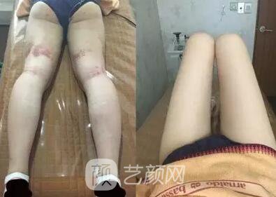 東莞締美陳星光大腿吸脂照片 內附全部恢復過程體驗