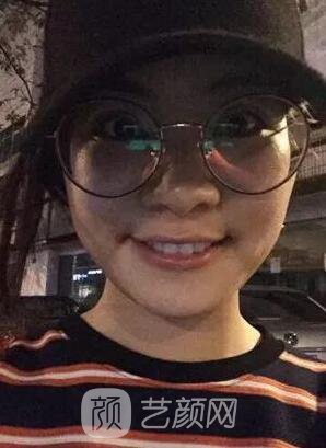西安碑林西美王艷娜雙眼皮圖 真實(shí)案例心情分享