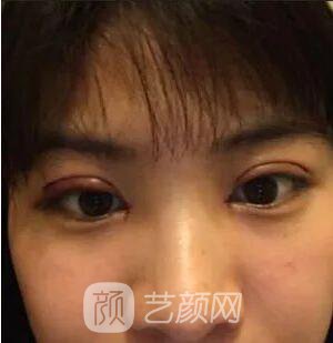 西安碑林西美王艷娜雙眼皮圖 真實(shí)案例心情分享