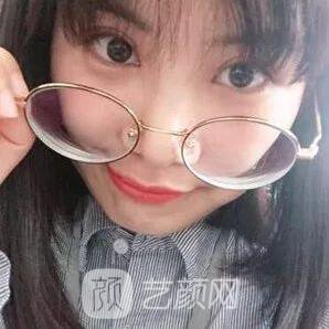 西安碑林西美王艷娜雙眼皮圖 真實(shí)案例心情分享