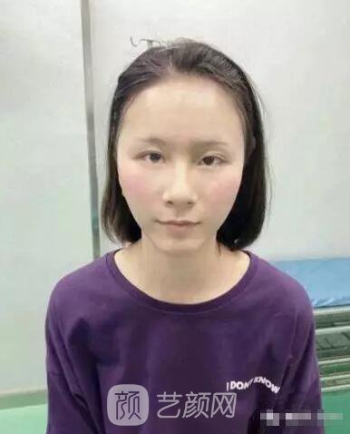 北京上上相鄭楚蓉院長自體脂肪填充全臉圖心情小記