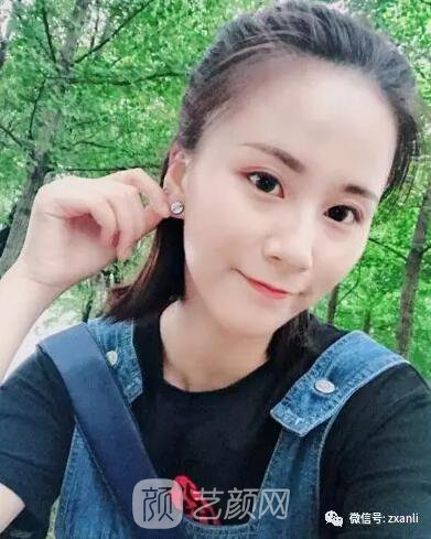 北京上上相鄭楚蓉院長自體脂肪填充全臉圖心情小記