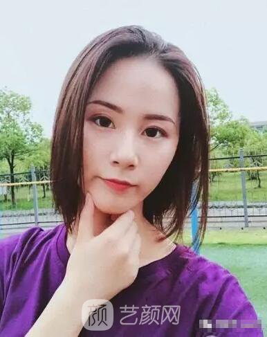 北京上上相鄭楚蓉院長自體脂肪填充全臉圖心情小記