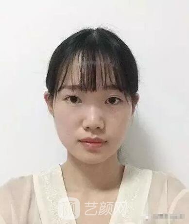 王紅敏切開(kāi)雙眼皮+開(kāi)內(nèi)眼角圖術(shù)后心情小述