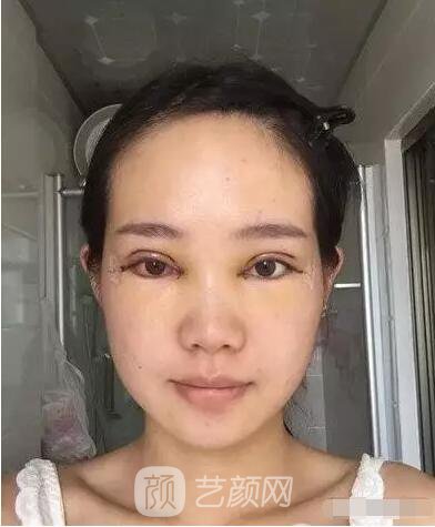 王紅敏切開(kāi)雙眼皮+開(kāi)內(nèi)眼角圖術(shù)后心情小述