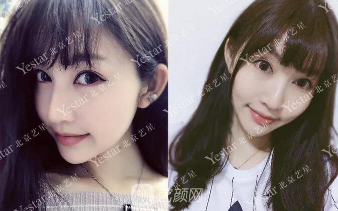 北京藝星整形醫(yī)院注射瘦臉￥499 | 打完半個(gè)月，來看看果!