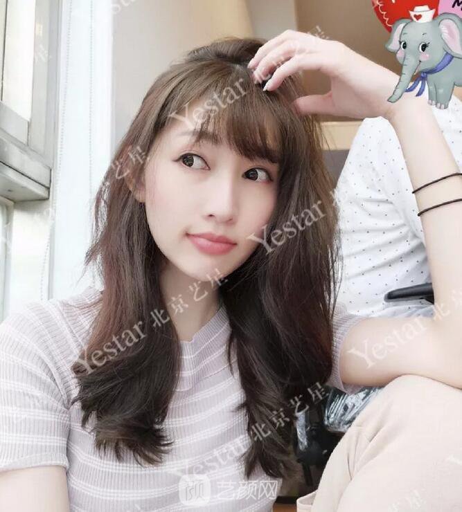 北京藝星整形醫(yī)院注射瘦臉￥499 | 打完半個(gè)月，來看看果!