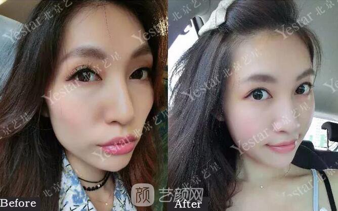 北京藝星整形醫(yī)院注射瘦臉￥499 | 打完半個(gè)月，來看看果!