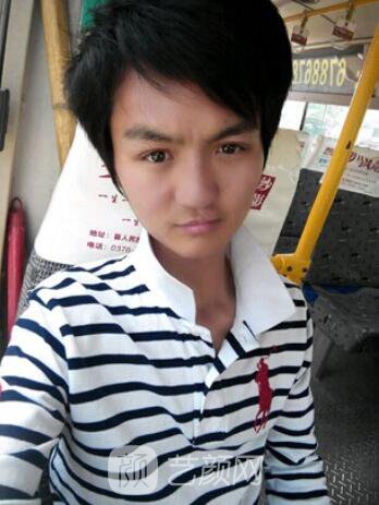 熊清華唇腭裂整形修復(fù)案例照片