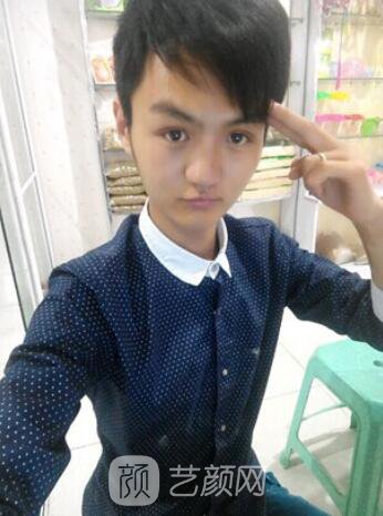 熊清華唇腭裂整形修復(fù)案例照片