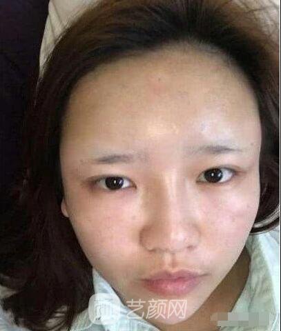 艾紅梅面部自體脂肪填充手術(shù)圖心情分享