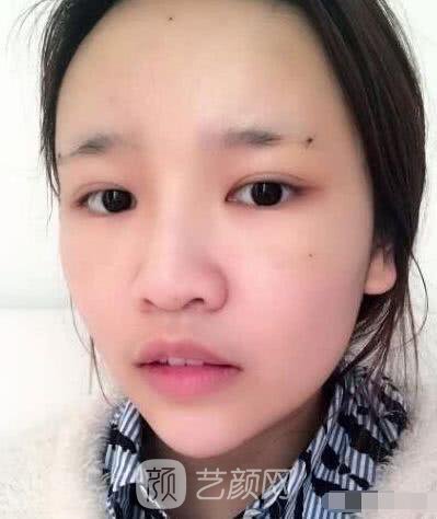 艾紅梅面部自體脂肪填充手術(shù)圖心情分享