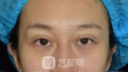 北京西美整形全切雙眼皮，徹底拯救我的大小眼