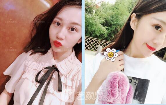 北京西美整形全切雙眼皮，徹底拯救我的大小眼