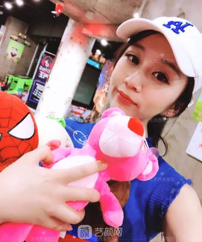 北京西美整形全切雙眼皮，徹底拯救我的大小眼