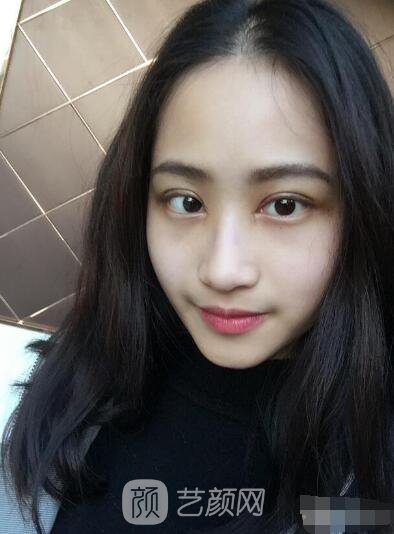 萍鄉(xiāng)優(yōu)美整形李清芳全切雙眼皮照片 拯救眼睛不對(duì)稱