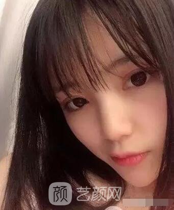上海伊美爾港華醫(yī)院開雙眼皮圖 大小眼的救星