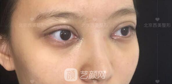 北京西美整形醫(yī)院全切雙眼皮真人案例圖|內(nèi)附恢復過程哦~