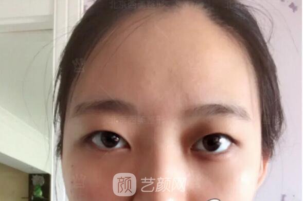 北京西美整形醫(yī)院全切雙眼皮真人案例圖|內(nèi)附恢復過程哦~