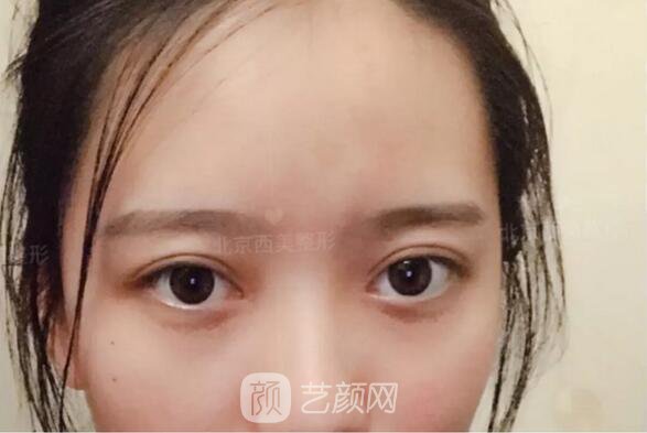 北京西美整形醫(yī)院全切雙眼皮真人案例圖|內(nèi)附恢復過程哦~