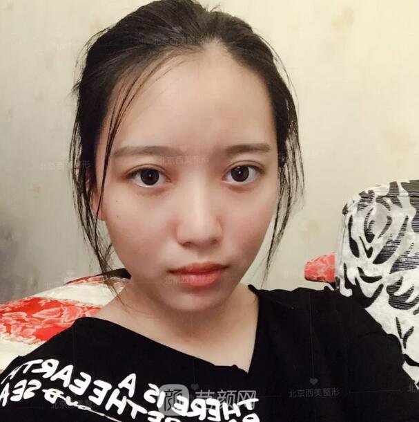 北京西美整形醫(yī)院全切雙眼皮真人案例圖|內(nèi)附恢復過程哦~