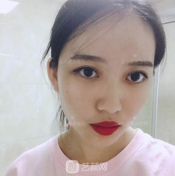 北京西美整形醫(yī)院全切雙眼皮真人案例圖|內(nèi)附恢復過程哦~