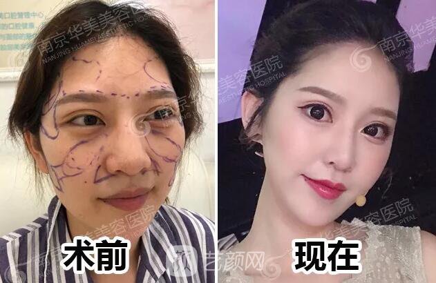 南京華美裴旭芳怎么樣?自體脂肪填充全臉真人案例