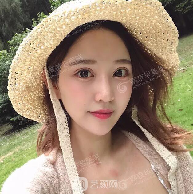 南京華美裴旭芳怎么樣?自體脂肪填充全臉真人案例