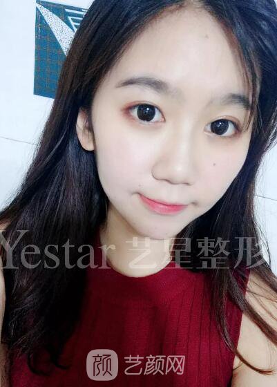 南京藝星割雙眼皮案例半年圖