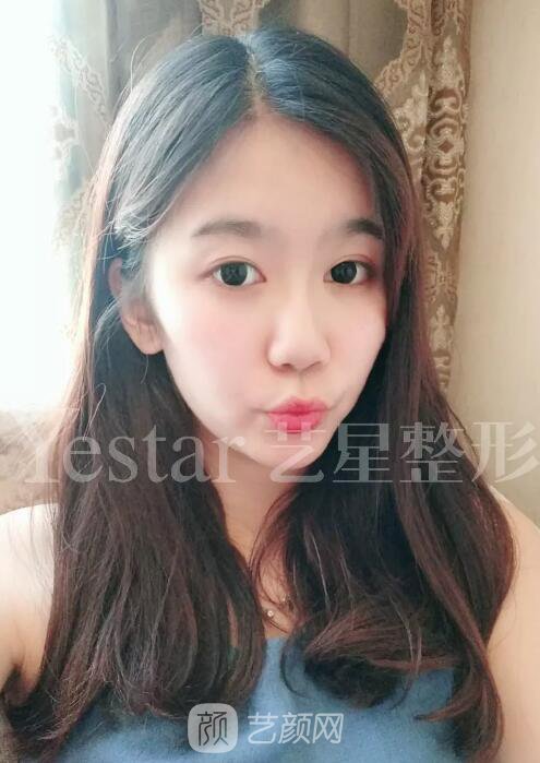 南京藝星割雙眼皮案例半年圖