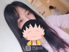 成都嬌點(diǎn)姜宇祿雙眼皮修復(fù)案例，重獲新生！