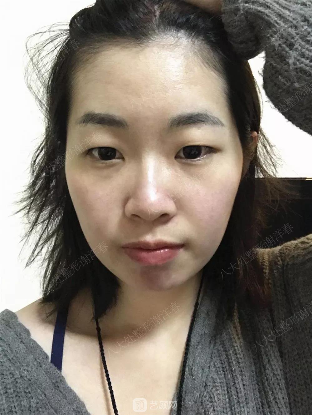 北京八大處割雙眼皮恢復(fù)過程，內(nèi)附圖