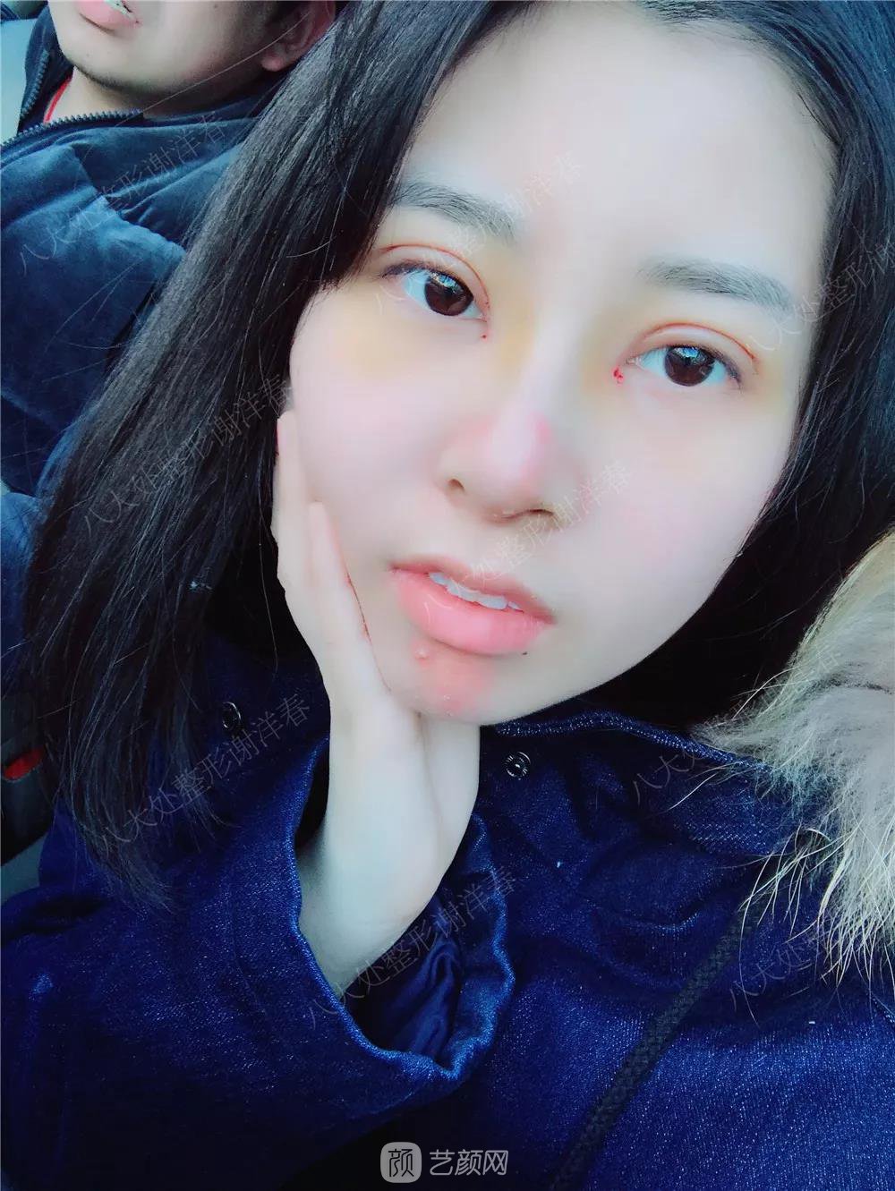北京八大處割雙眼皮恢復(fù)過程，內(nèi)附圖