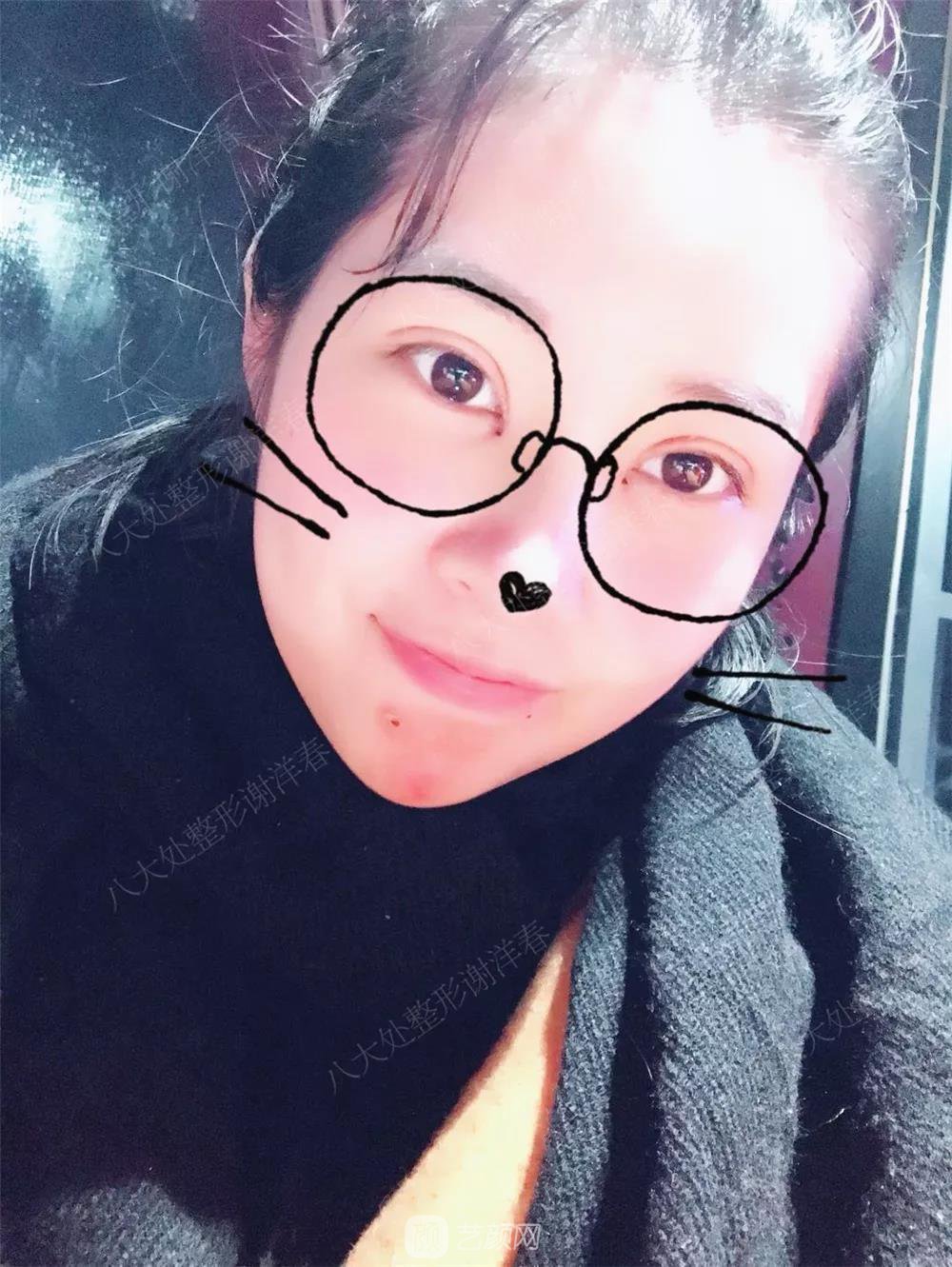 北京八大處割雙眼皮恢復(fù)過程，內(nèi)附圖