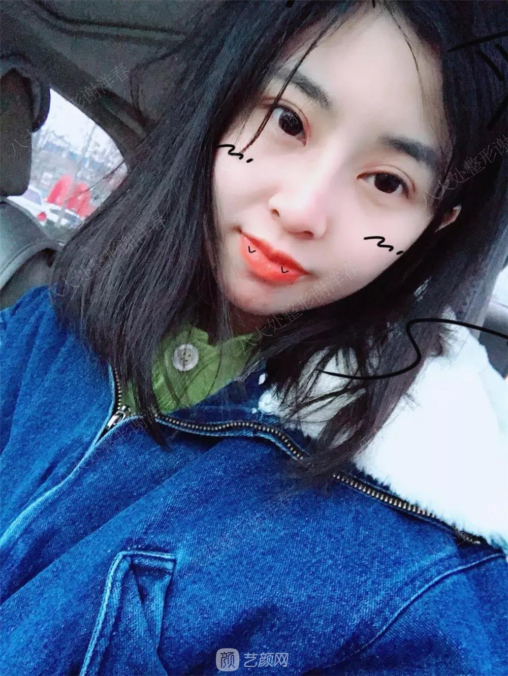 北京八大處割雙眼皮恢復(fù)過程，內(nèi)附圖