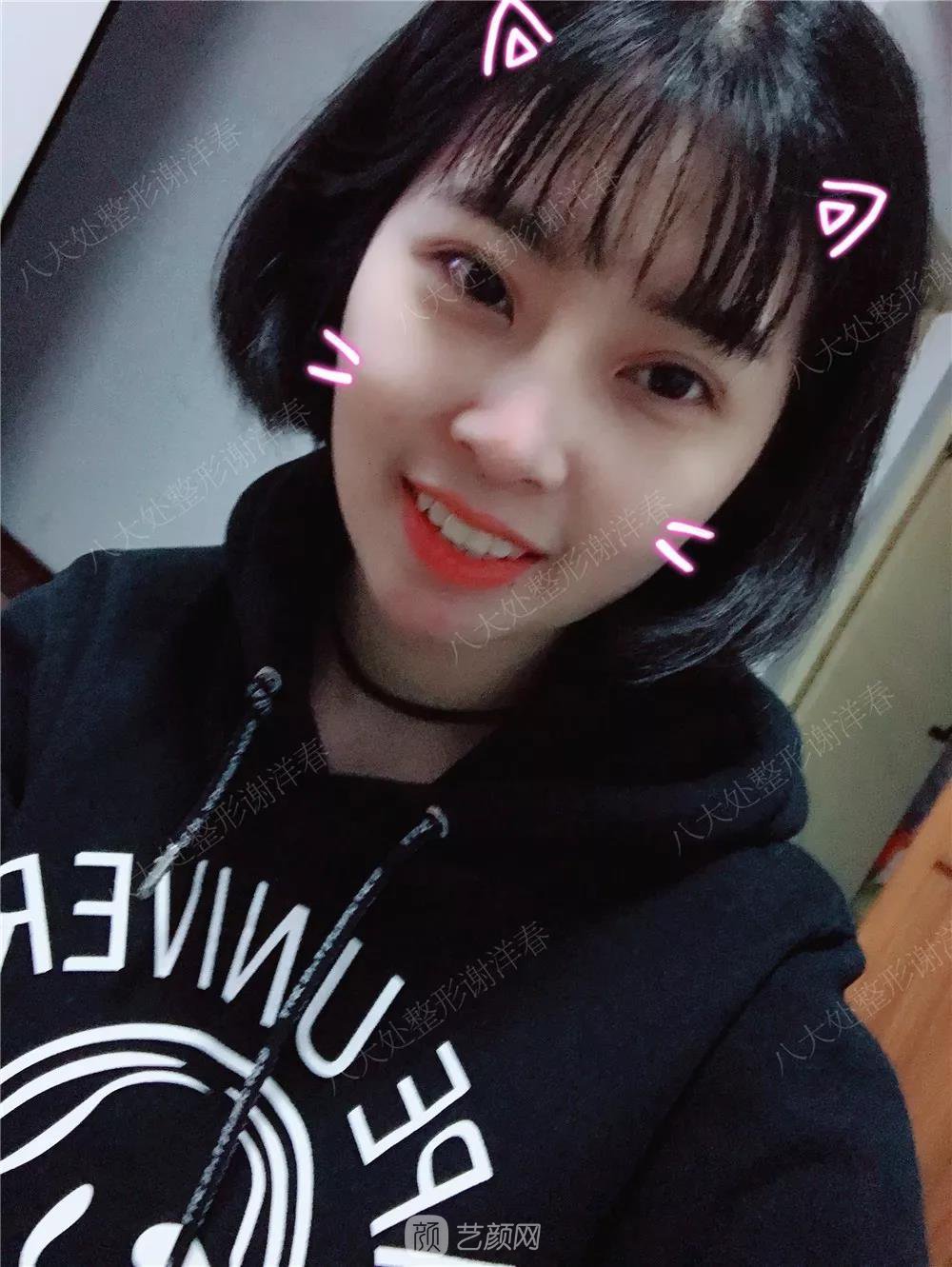 北京八大處割雙眼皮恢復(fù)過程，內(nèi)附圖