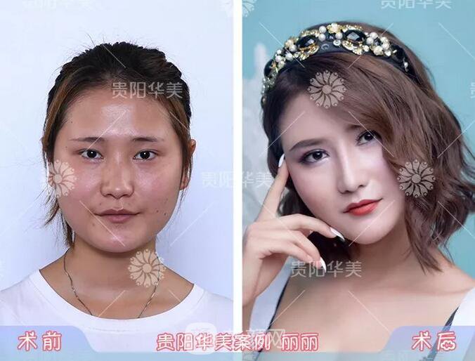 貴陽華美謝占軍割雙眼皮+隆鼻真人案例圖分享